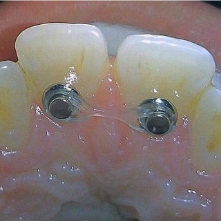 Buton chỉnh nha-nút chỉnh nha button