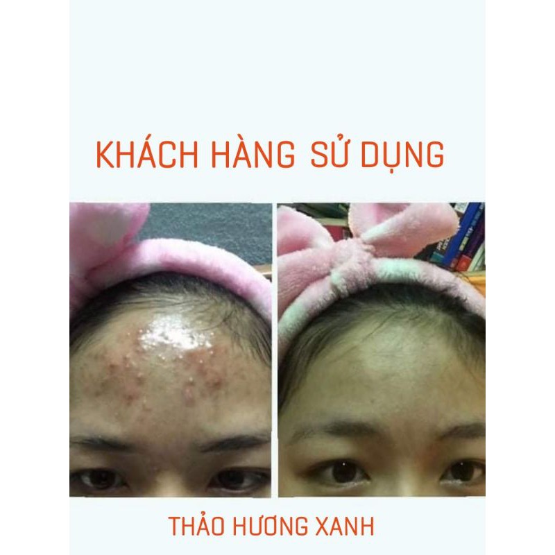 THẢO HƯƠNG XANH  SẠCH MỤN,HẾT THÂM