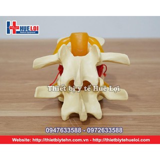 Mô Hình xương Thoát vị Đĩa Đệm