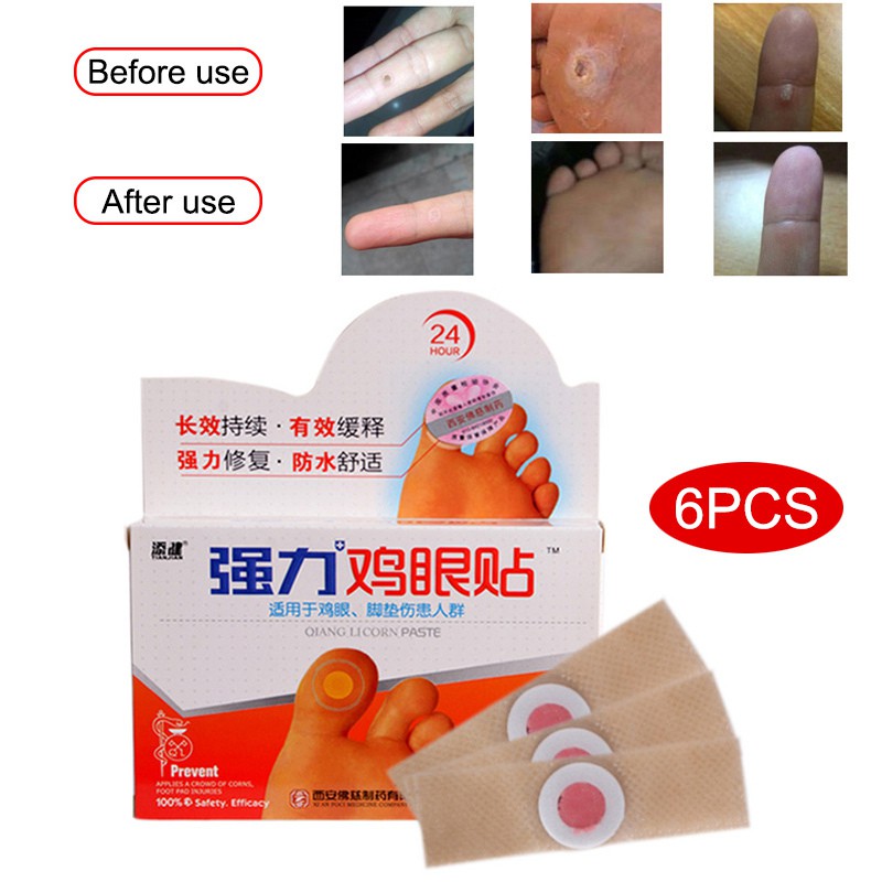 (Hàng Mới Về) Set 6 Miếng Dán Trị Mụn Cóc Tiện Dụng Chất Lượng Cao