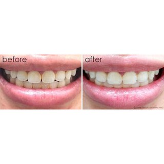 Miếng dán trắng răng Crest 3D Professional Effects hàng Mỹ