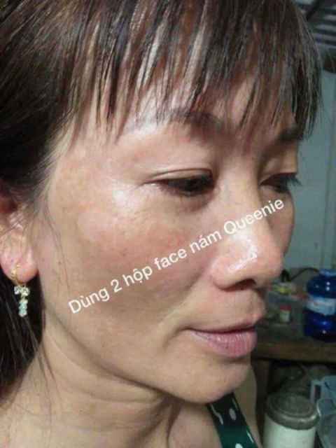 Kem nám, tàn nhan Queenie skin | BigBuy360 - bigbuy360.vn