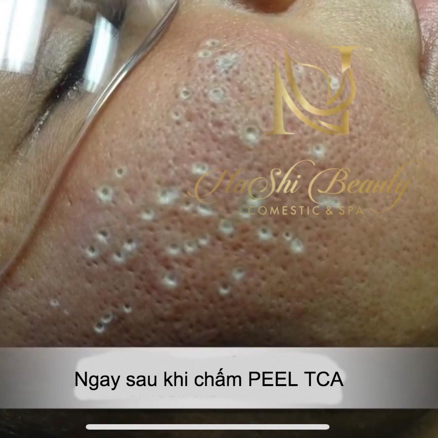 Peel TCA Làm Đầy Sẹo Rỗ Sẹo Lõm - Tặng 2 Chai Tế Bào Gốc |  TRICHLOROACETIC ACID