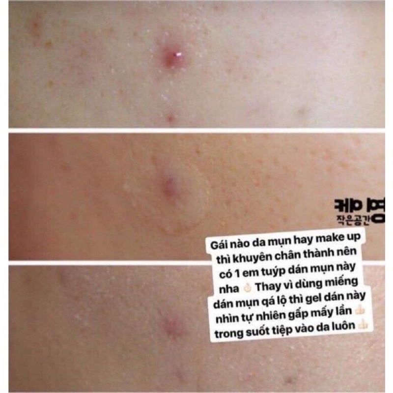 Gel bảo vệ da mụn rau má Prreti loại bỏ bã nhờn chăm sóc da dịu nhẹ tự nhiên 10g