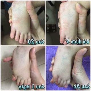 CAO BÔI MUỖI ĐỐT