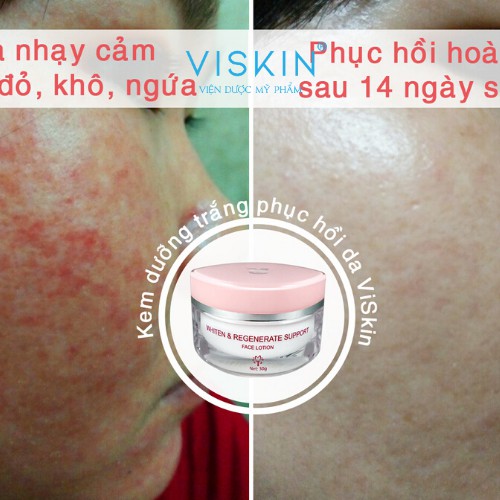 Kem Dưỡng Trắng Và Phục Hồi Da Nhiễm Corticoid Viskin VS04 - Tái Sinh Làn Da Khỏe Mạnh Trắng Hồng Tự Nhiên