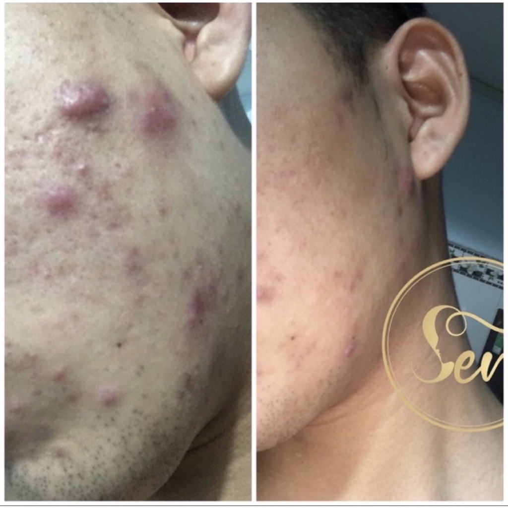 Serum Detox Sen 30ml Chấm Mụn Dược Phẩm Mỹ Phẩm Sen