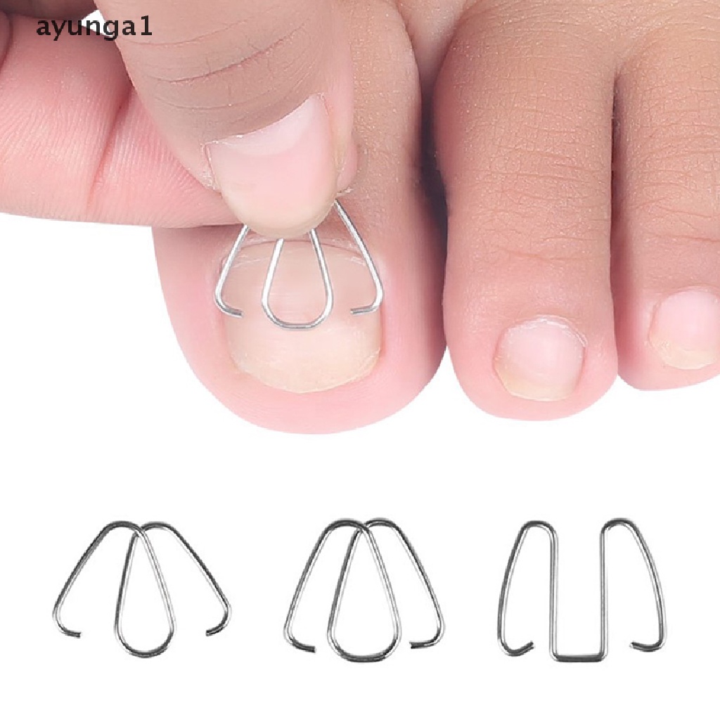 [ayunga1] Nail Art Ingrown Toe Nail Correction Tool Toenail Nail Orthosis Paronychia Clip [new]