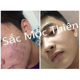 Cải Thiện Mụn, Thâm Nám, Tàn Nhang, Rỗ Tái Tạo Da Sắc Mộc Thiên hàng chuẩn bán Sỉ