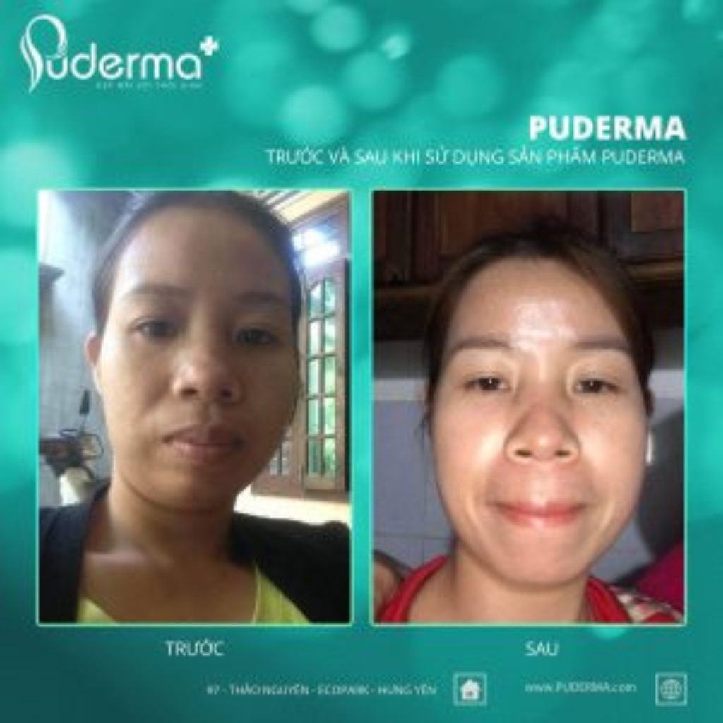 Tẩy Da Chết Puderma Advanced Refreshing Peeling Gel Giúp Làm Sạch Tế Bào Da Chết, Mang Lại Làn Da Mịn Màng, Tươi Sáng