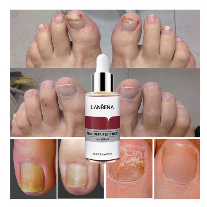 Serum Lanbena Nuôi dưỡng Tái tạo móng - Giải quyết mọi vấn đề về móng tay chân VG