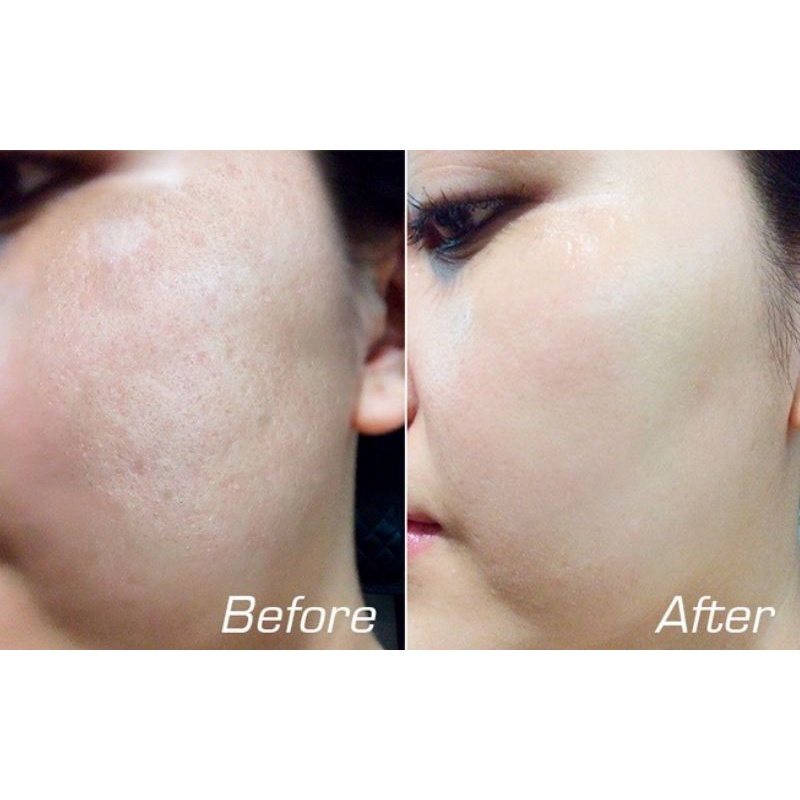 Peel chấm TCA 50%,75%, 80% Làm Đầy Sẹo Rỗ Sẹo Lõm Splendora | TRICHLOROACETIC ACID - Tặng kèm bao tay y tế