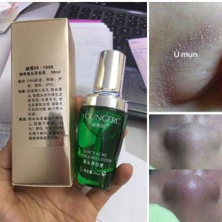 Ủ Mụn Younger Lotion Đẩy Nhân Mụn Khô Đầu Trước Khi Nặn chuyên dụng cho Spa