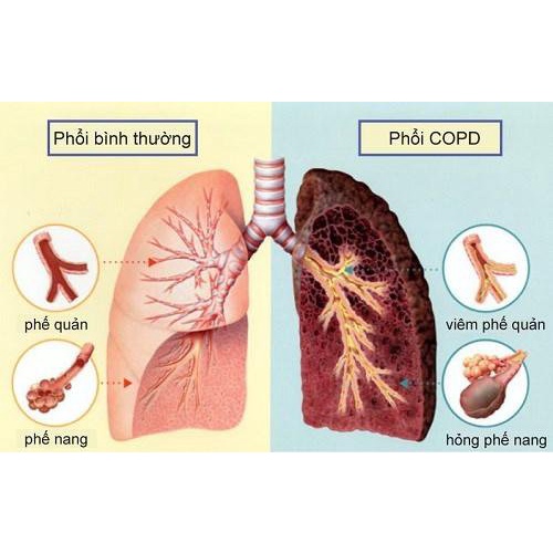 Viên Uống BoniDetox (Hộp 30 viên) - Bí kíp vàng hỗ trợ giải độc phổi và giảm nguy cơ u bướu phổi của Mỹ
