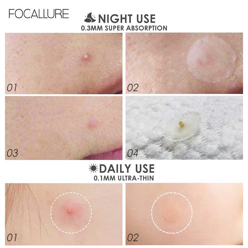 Miếng Dán Lấy Nhân Mụn FOCALLURE Chống Thấm Nước, Giảm Sưng Mụn