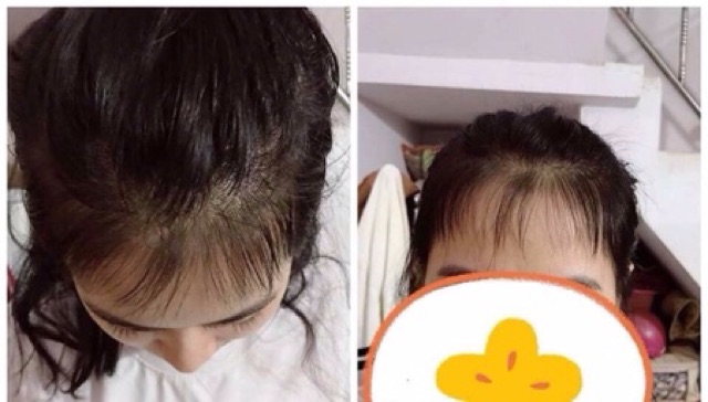 Combo ngăn rụng kích mọc tóc VyvyHairCare