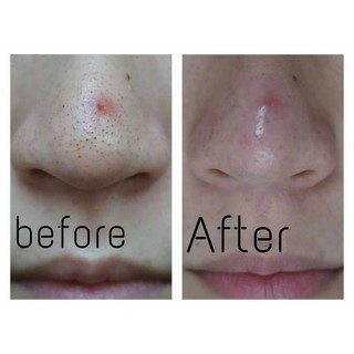 Miếng Dán Mụn Ciracle Goodbye Blackhead  (1 Miếng)