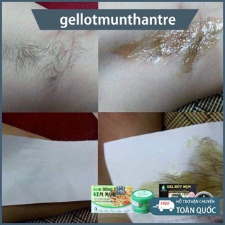 COMBO TRIỆT LÔNG NGÂN BÌNH – SÁP WAX LẠNH + MỠ TRĂN NGUYÊN CHẤT 50ML