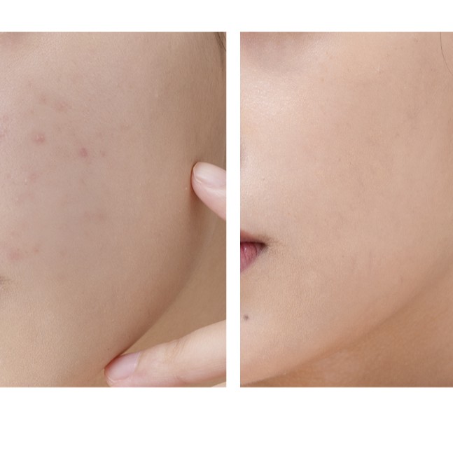 LUCENBASE | Tinh Chất Giảm Mụn, Giảm Thâm Mụn Serum Lucenbase Oligopeptide Giảm Mụn Giảm Thâm Phục Hồi Da Làm Dịu Da | BigBuy360 - bigbuy360.vn