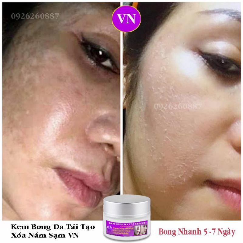 Kem Bong Da Tái Tạo VN