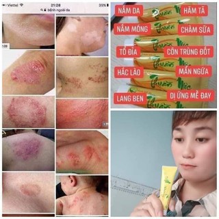 Kem bôi ngoài da
