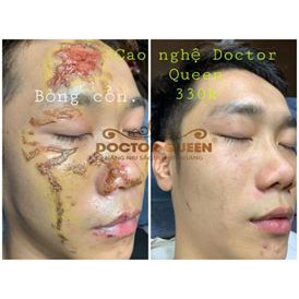 CAO NGHỆ DOCTORQUEEN (ngừa thâm nám,mụn,bỏng,sẹo,ngã xe các vết thương,...làm sáng da,)