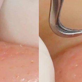 NHÍP GẮP MỤN THẦN THÁNH