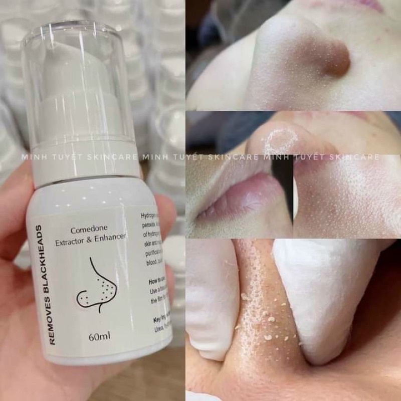 Ủ MỤN XỬ LÝ MỤN ĐẦU ĐEN REMOVE BLACKHEAD HÀNG SPA