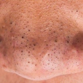 GEL HÚT MỤN DR.ACNE