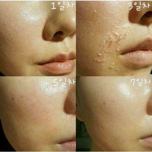Thay Da Sinh Học BQCELL Derma Skin Peeling - Hàn Quốc | BigBuy360 - bigbuy360.vn