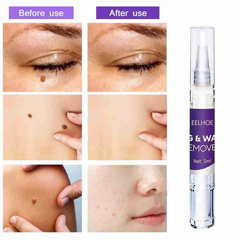 [Hàng mới về] Dung dịch loại bỏ mụn cóc / nốt ruồi A8T2