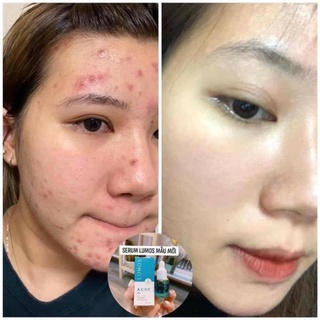 Serum mụn Lumos mẫu mới 2021