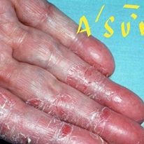 Kem bôi _dalieu . nấm ngoài da, á sừng ...khó chịu