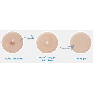 Miếng Dán Giảm Mụn COSRX Acne Pimple Master Patch