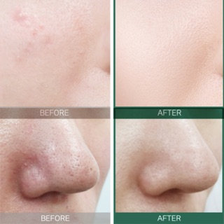 Tinh chất AHA - BHA - PHA 30days Miracle Serum