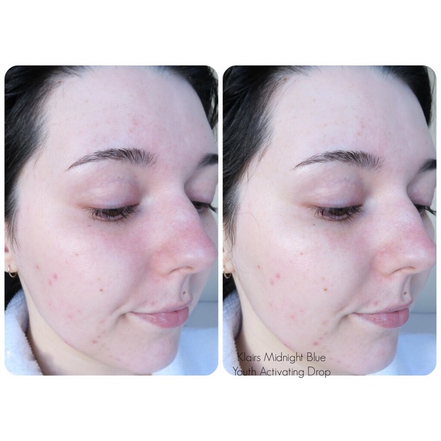 Tinh chất phục hồi da sau mụn Klairs Midnight Blue Youth Activating Drop Serum