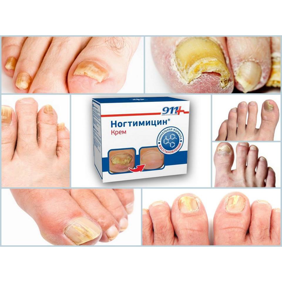 KEM BÔI NẤM MÓNG, NUÔI DƯỠNG VÀ THAY MÓNG MỚI KPEM TWISTEC NOGTIMITSIN