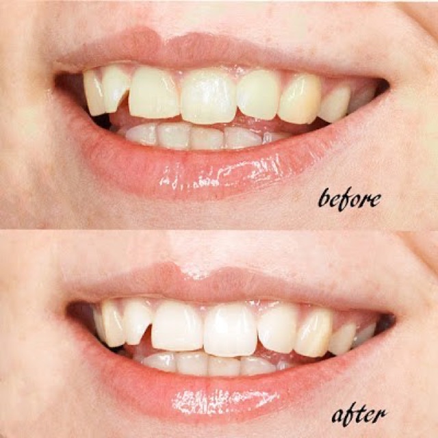 🌟 Bộ làm trắng răng White Glo White Accelerator Blue Light Teeth Whitening System