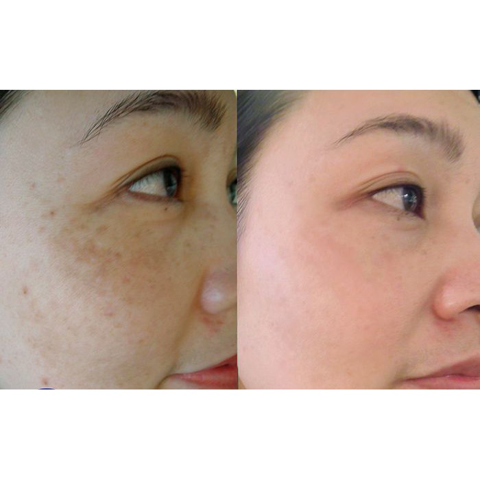 Kem làm mờ thâm nám và dưỡng trắng da White Shinno Nhật Bản