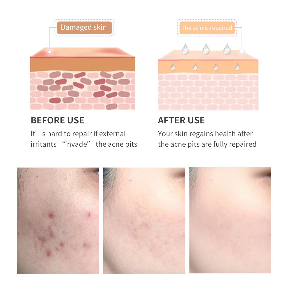 Gel giảm mụn Breylee 30g