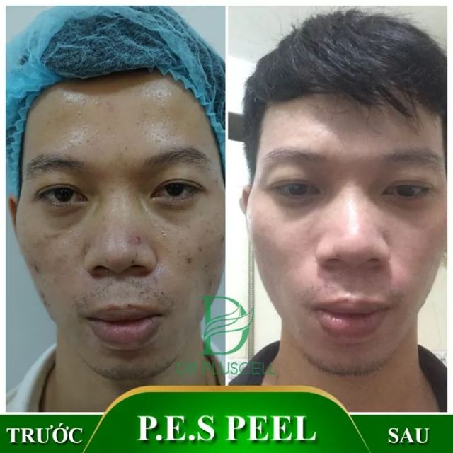 [TRỢ GIÁ] Bộ 2 Pes peel mụn Dr Pluscell