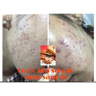 CAO MỤN SÂM ĐỎ_ CHÍNH HÃNG 100%