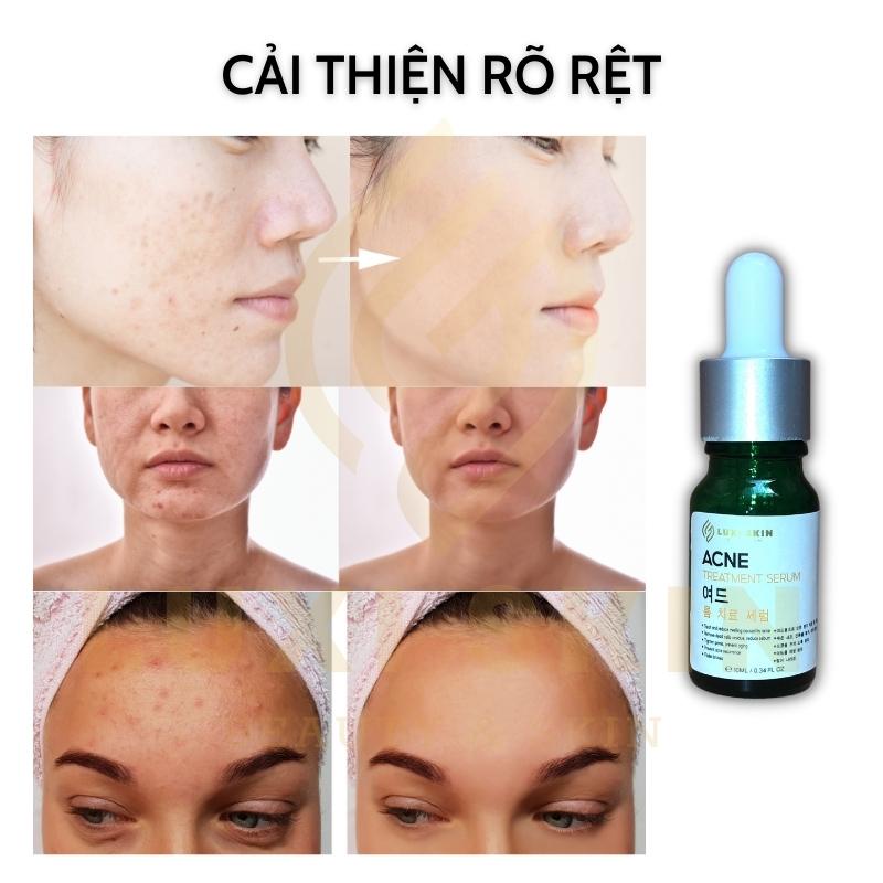 Serum giảm mụn mờ thâm rỗ LUXI SKIN ACNE TREATMENT 10ml  LOSADE serum diếp cá