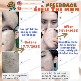 Huyền Dịch Giảm Mụn Cấp Tốc BOLTUSHKA