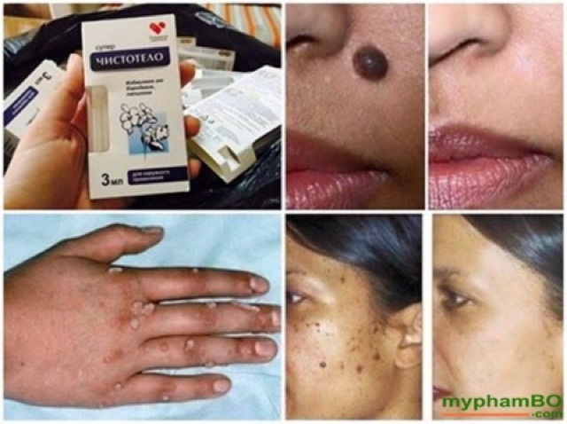 Gel tẩy nốt ruồi mụn cóc mụn thịt sẹo lồi Dvelinil Của Nga Sena Beauty | BigBuy360 - bigbuy360.vn