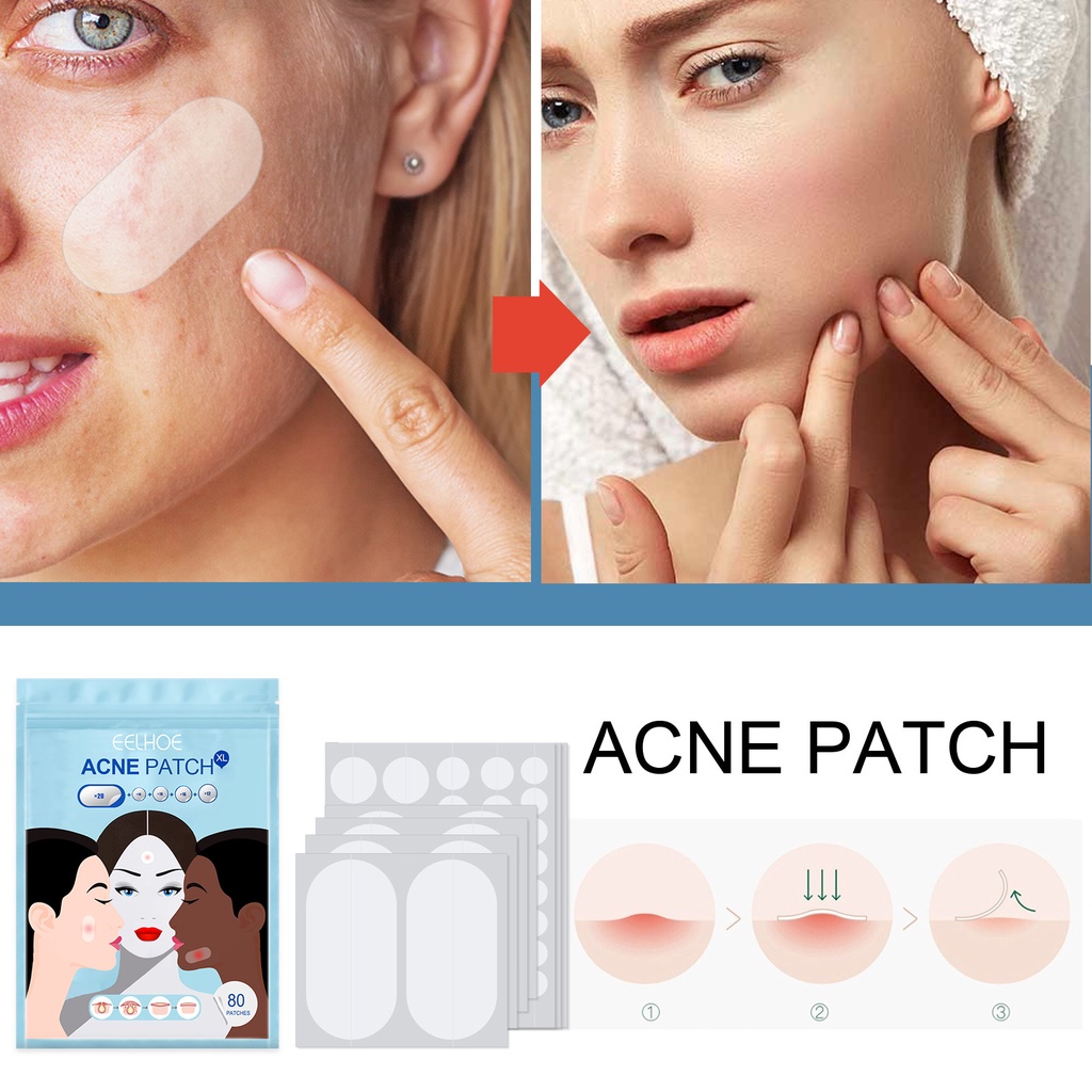 Set 80 Miếng Dán Hỗ Trợ Giảm Mụn Vô Hình Chống Thấm Nước