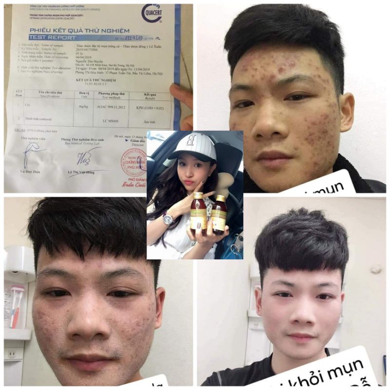 Tinh chất ngừa mụn trứng cá Lê Xuân 🍀Free ship☘️loại bỏ mụn đầu đen, mụn ẩn, mụn bọc,… | BigBuy360 - bigbuy360.vn