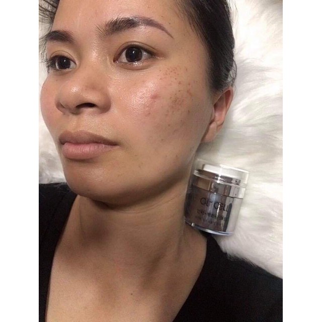 Kem hút nám tàn nhang ol cell . | BigBuy360 - bigbuy360.vn