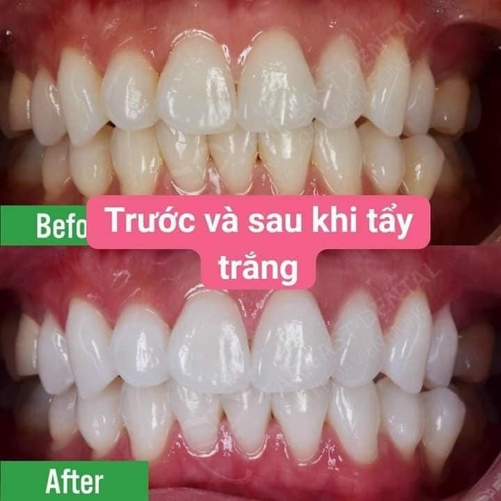 BÚT LÀM TRẮNG RĂNG DAZZLING WHITE TIỆN DỤNG