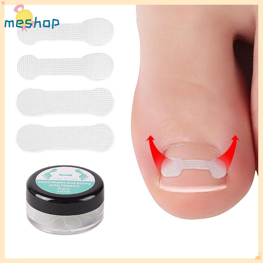 Set 10 Miếng Dán Điều Chỉnh Móng Chân Tiện Lợi